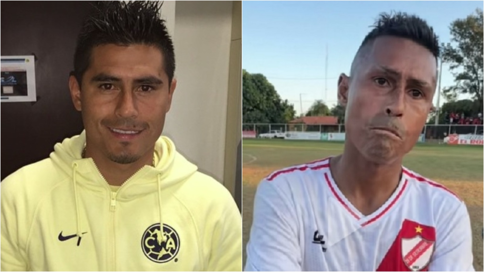 Osvaldo Martinez, Exfutbolista del América, Preocupa por su Estado Físico.  ¿Qué Es la Esclerodermia, Enfermedad que Padece? | N+