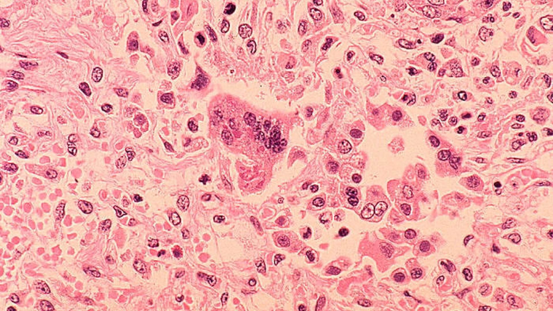 ¿Cómo se Manifiesta el Sarampión? Lista de Síntomas en Adultos y Niños ...