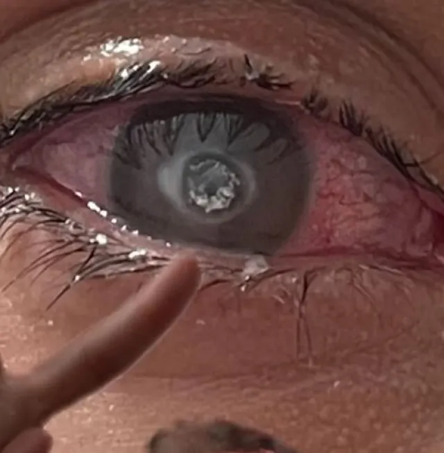Joven Pierde un Ojo por Usar Mal los Lentes de Contacto