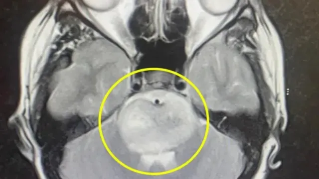 , tenía migrañas severas y tuvo una desviación de su ojo izquierdo hacia el centro de su cara,